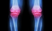 California Department of Insurance Sues AbbVie Over Arthritis Drug Marketing