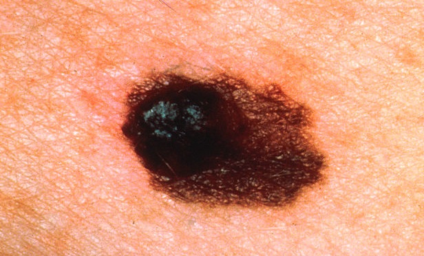 skin cancer